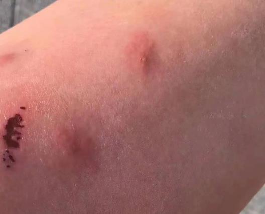 洪水|注意！洪水过后，需警惕这些皮肤问题，处理方法来了