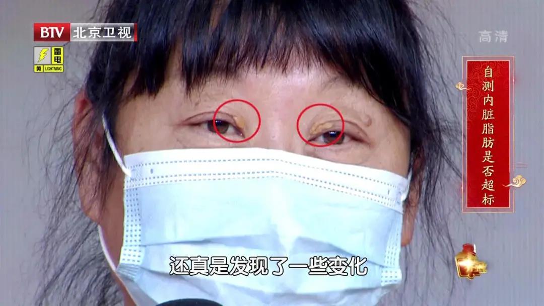 高血脂|这种高血脂会堵血管、致心梗，还会“传染”给家人！