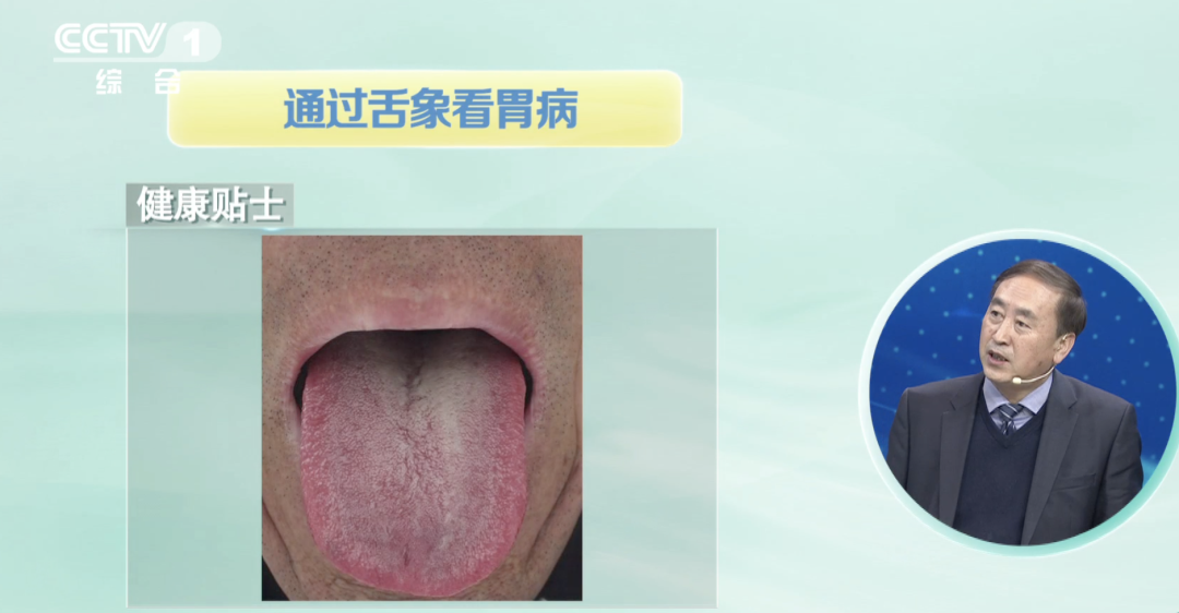 从胃炎到胃癌只需4步!控制它是早期最有力的阻断方法