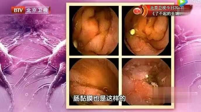 它是胃癌的"帮凶",几乎每2个人中就有1个中招!这样做能预防…