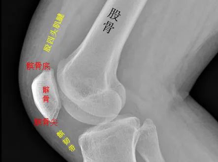 女性的膝盖更易“跑偏”,一个动作就知道它稳不稳