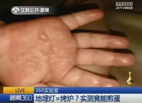 被可乐炸伤,脸缝 38 针 | 夏天的 70 个致命隐患,千万小心