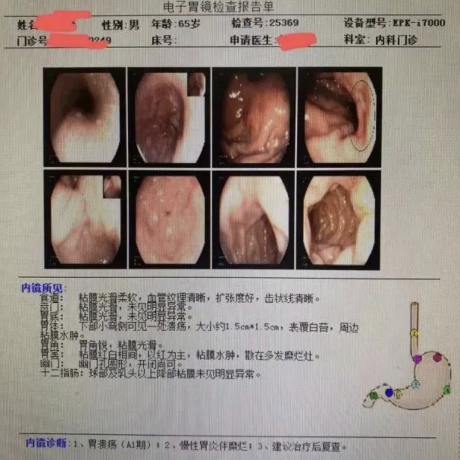 把胃溃疡拖成胃癌，医生提醒：这9种“小病”拖不得！