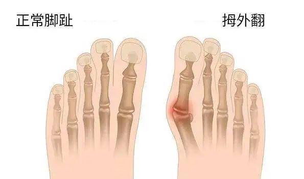 拇外翻:每个被“穿歪”的脚趾,都不是无辜的